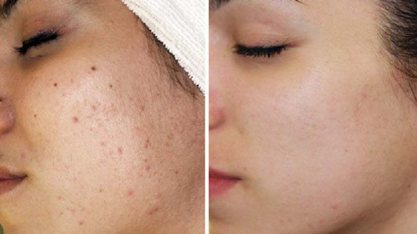 BHA trị mụn trứng cá và cách sử dụng an toàn