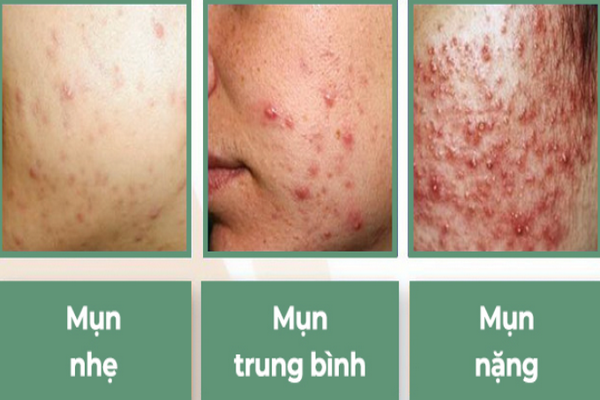 Thuốc điều trị mụn trứng cá hiệu quả nhất