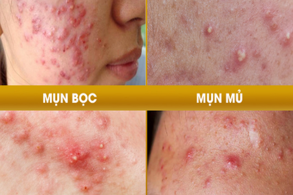 Điều trị mụn trứng cá bằng laser và những điều bạn nên biết