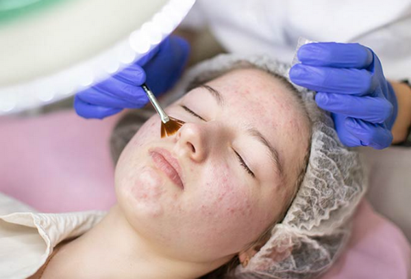 Điều trị mụn trứng cá bằng laser và những điều bạn nên biết