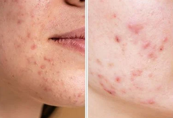 Serum trị mụn trứng cá và cách sử dụng hiệu quả