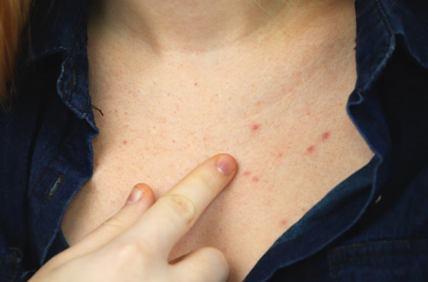 Mụn trứng cá ở vùng ngực và những thông tin liên quan