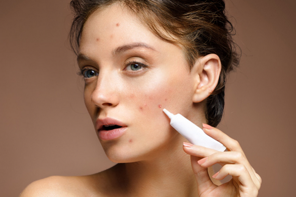 Trị mụn trứng cá bằng thuốc nam có thực sự hiệu quả?