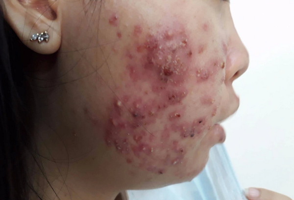 Trị mụn trứng cá bằng thuốc nam có thực sự hiệu quả?