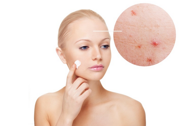 Mụn trứng cá có tự khỏi không? Bí quyết giảm mụn nhanh chóng