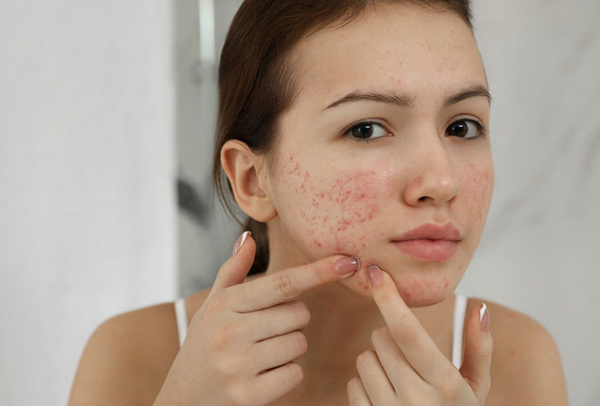 Mụn trứng cá có tự khỏi không? Bí quyết giảm mụn nhanh chóng