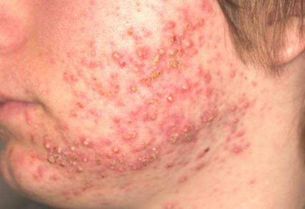 Mụn trứng cá có tự khỏi không? Bí quyết giảm mụn nhanh chóng