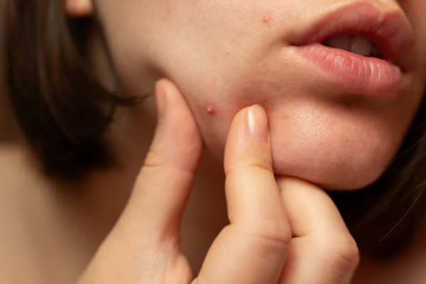 Mụn bọc sưng đau và cách kiểm soát