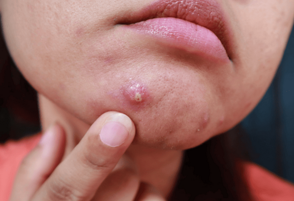 Mụn trứng cá bọc sưng đau và cách kiểm soát