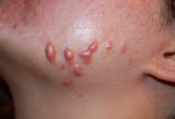 Mụn trứng cá có gây sẹo không? Cách phòng tránh sẹo do mụn