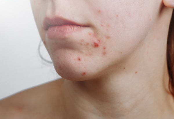 Mụn trứng cá tái phát không, hướng dẫn điều trị duy trì