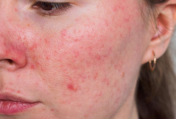 Mụn trứng cá tái phát không, hướng dẫn điều trị duy trì