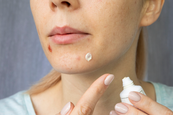Mụn mủ là gì? Cách điều trị mụn mủ hiệu quả