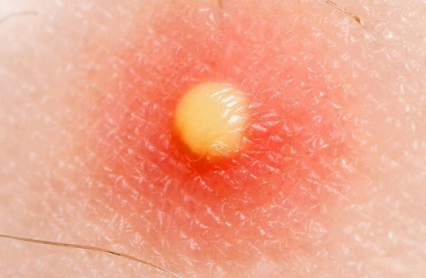 Mụn mủ là gì? Cách điều trị mụn mủ hiệu quả