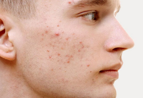 Các loại mụn trứng cá thường gặp và cách phân biệt