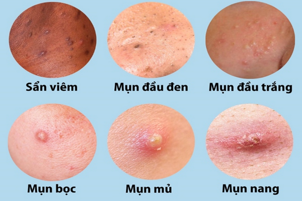Các loại mụn trứng cá thường gặp và cách phân biệt