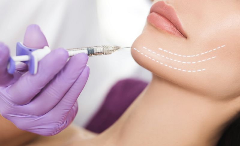 Tiêm Filler bao lâu thì đẹp tự nhiên?