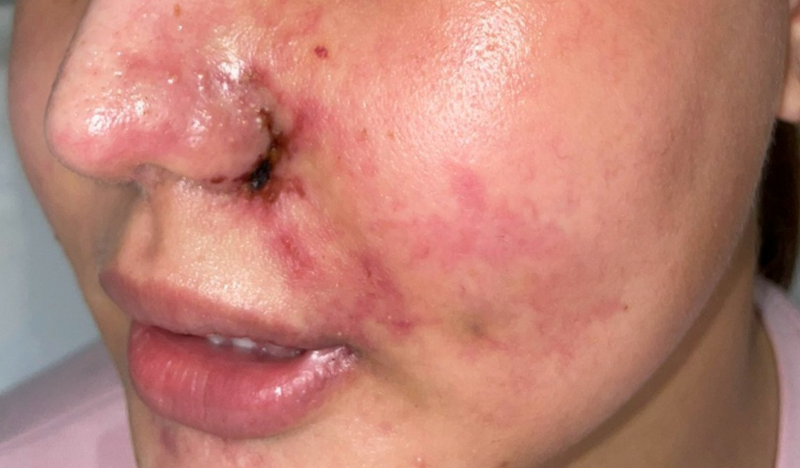 Tiêm filler giá rẻ: Lợi và hại cần cân nhắc