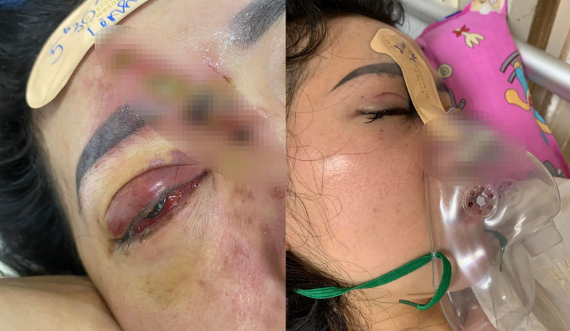 Tiêm filler giá rẻ: Lợi và hại cần cân nhắc