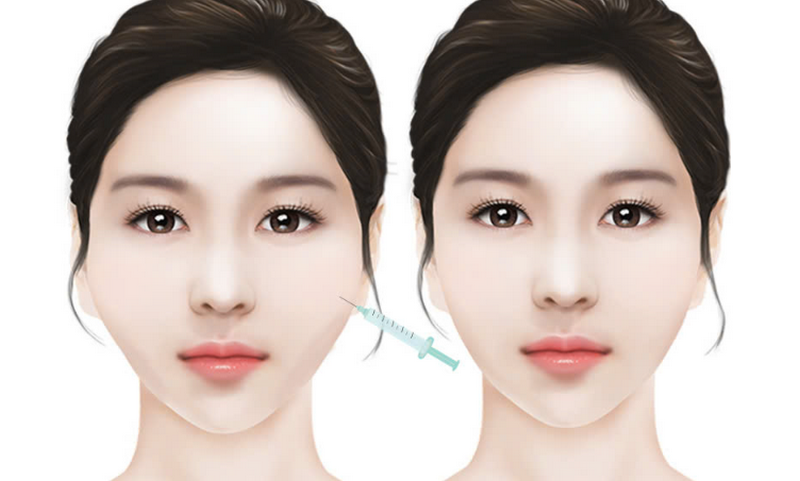 Tiêm filler má: Giải pháp thẩm mỹ giúp gương mặt trẻ trung, cân đối