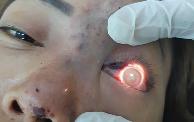 Tiêm filler má: Giải pháp thẩm mỹ giúp gương mặt trẻ trung, cân đối