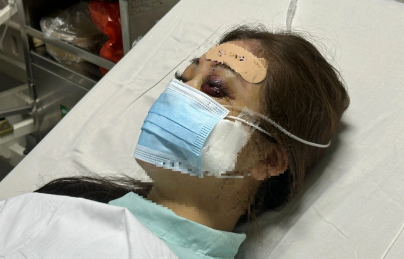 Tiêm filler tại nhà: Nguy cơ và cảnh báo từ chuyên gia