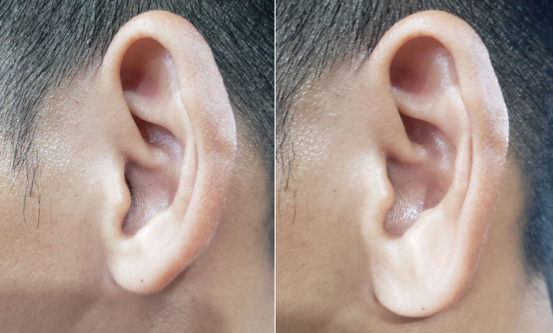 Tiêm filler cho nam giới: Xu hướng thẩm mỹ mới