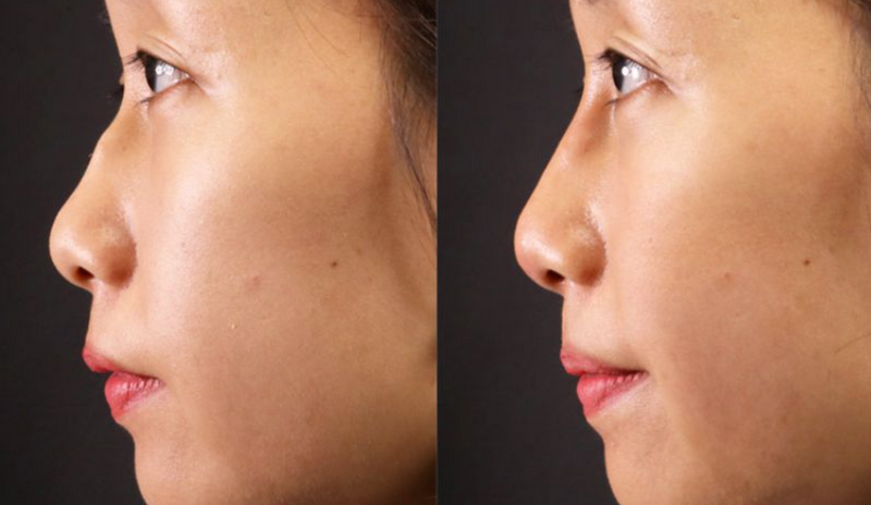 Dáng mũi thay đổi sau khi được tiêm 0.5cc filler