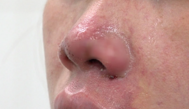 Không nâng mũi ở những nơi thiếu uy tín, giả rẻ để tránh gặp biến chứng tiêm filler mũi