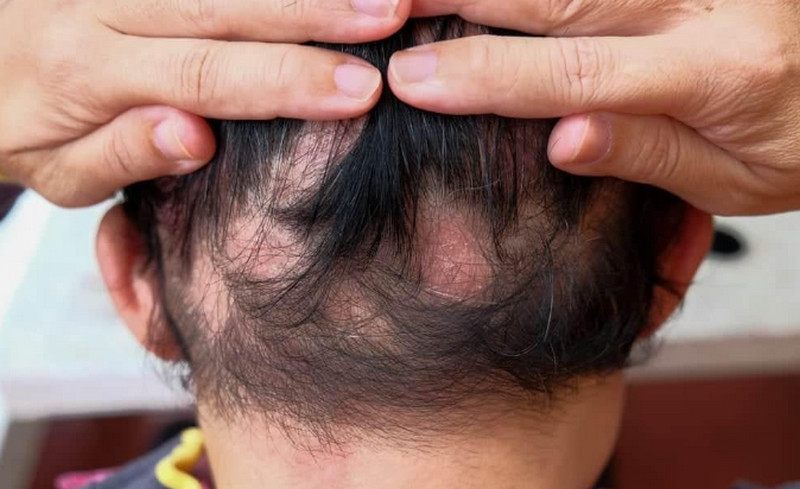 Rụng tóc nhiều ở nữ tuổi 17 có sao không?