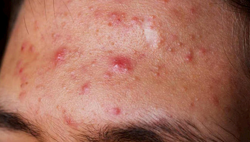 Cách làm xẹp mụn sưng đỏ sau 1 đêm, giải pháp cấp tốc cho làn da