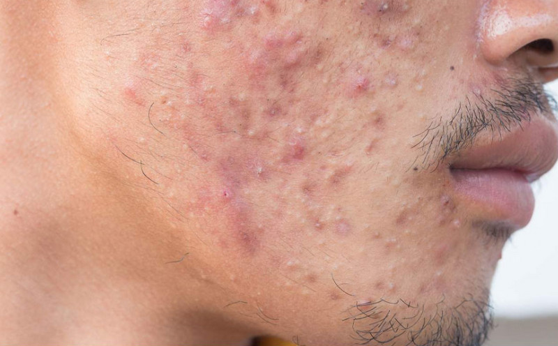 Thăm khám nếu thấy mụn lan rộng và kéo dài dai dẳng