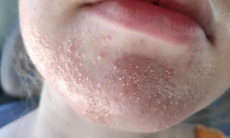 Mụn nấm men là gì? Nguyên nhân và cách điều trị hiệu quả