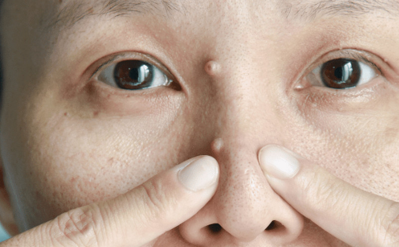 Mụn cơm ở mặt: Hiểu rõ nguyên nhân, cách điều trị dứt điểm