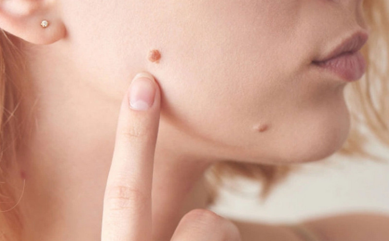 Mụn cơm ở mặt: Nguyên nhân, cách nhận biết và điều trị hiệu quả