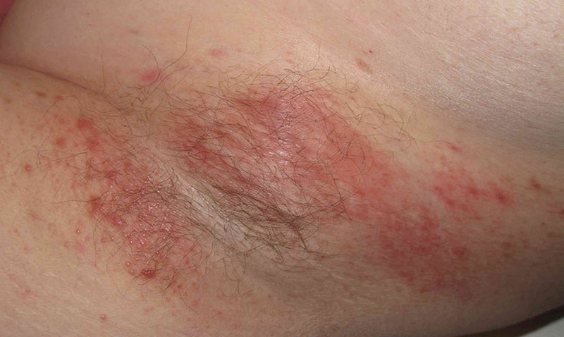 Các loại mụn ở nách và cách điều trị hiệu quả