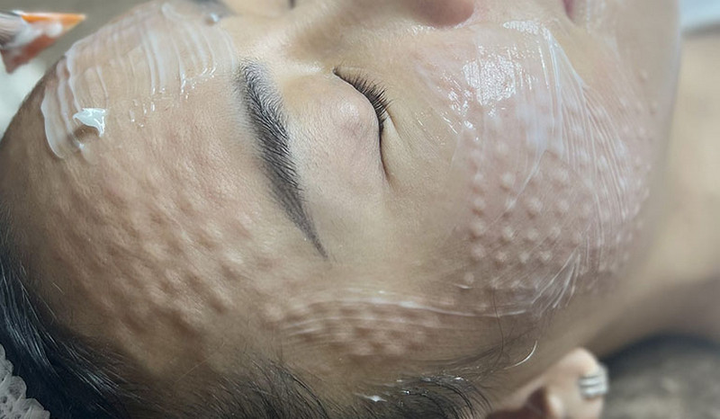 Tiêm HA giúp cấp ẩm cho da nhanh chóng, giảm tình trạng khô da và giúp phục hồi da hiệu quả