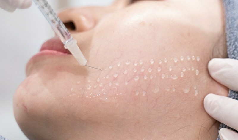 Meso phù hợp với nhiều tình trạng da bởi giải pháp thẩm mỹ này không cần nghỉ dưỡng