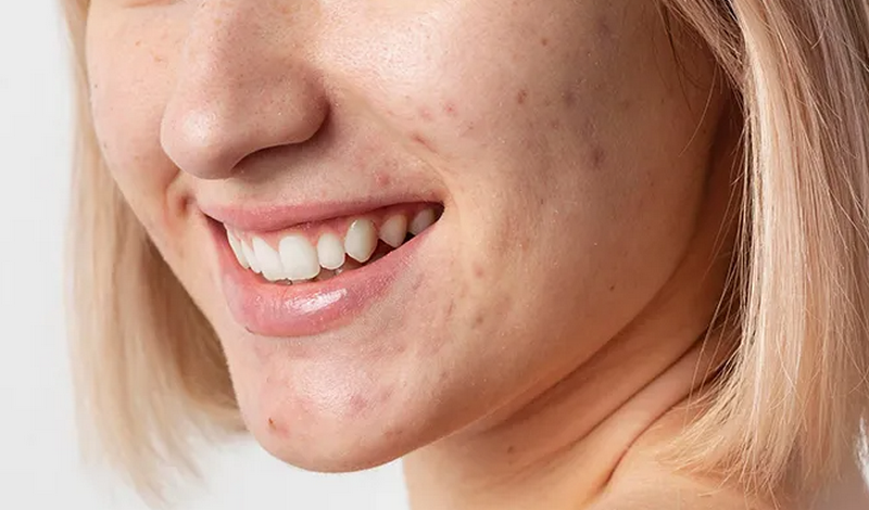 Tiêm meso trị mụn được không, giá bao nhiêu?