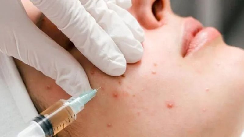 Tiêm meso trị mụn được không, giá bao nhiêu?