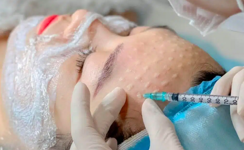 Tiêm meso phục hồi da an toàn và hiệu quả