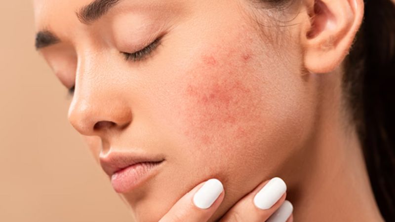 Tiêm meso trắng da được không, có an toàn không?