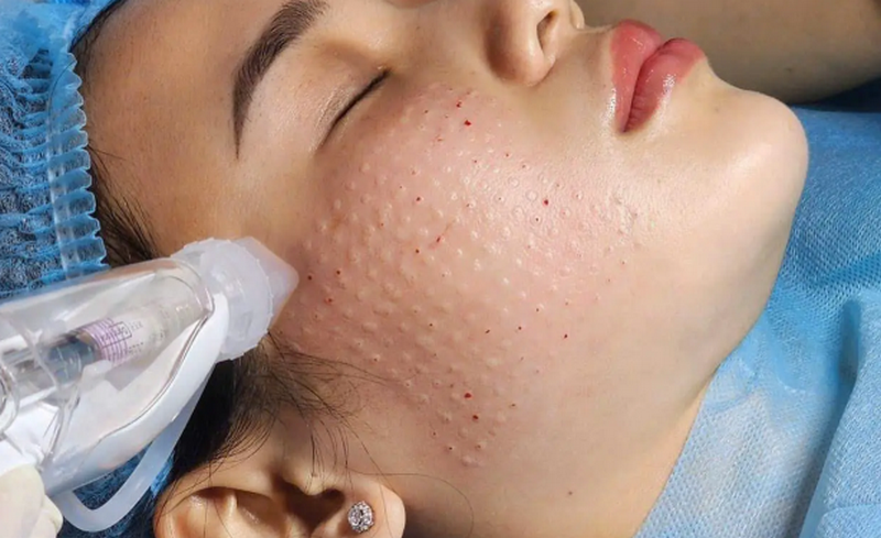 Liệu trình tiêm meso giá bao nhiêu tiền là hợp lý nhất