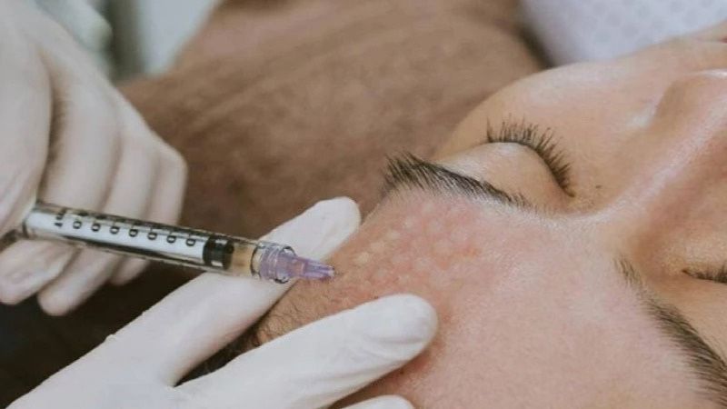 Tiêm meso và những điều bạn nên biết