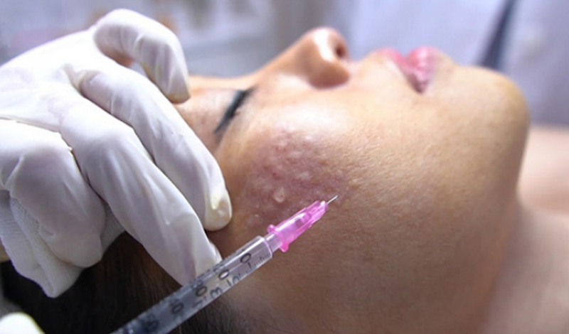 Tiêm meso và những điều bạn nên biết