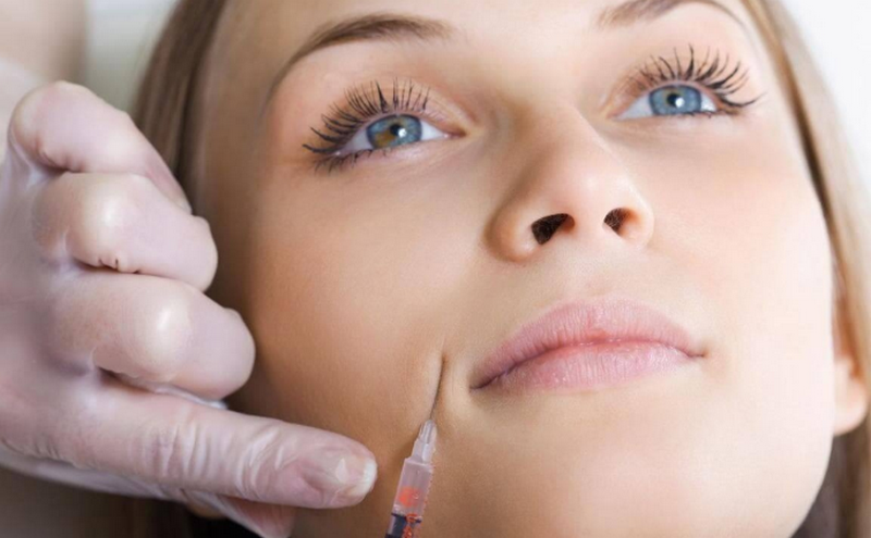 Tiêm rãnh cười: Giải pháp tìm lại nụ cười duyên dáng