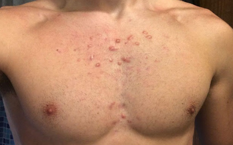 Mụn trứng cá ở vùng ngực và những thông tin liên quan