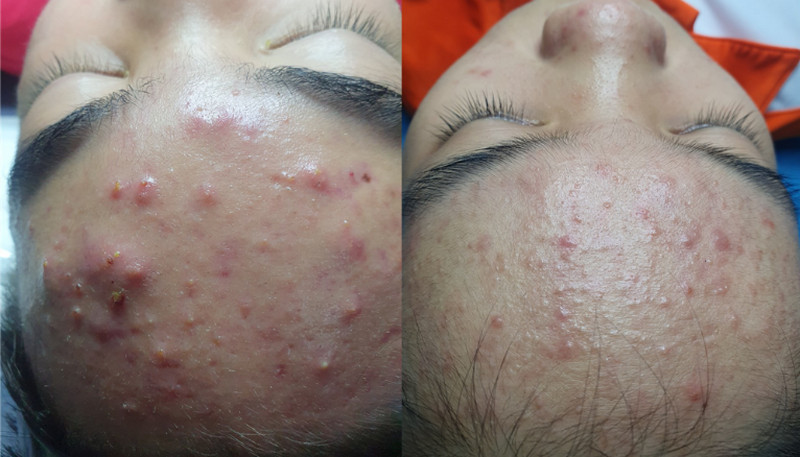 Mụn trứng cá có tự khỏi không? Bí quyết giảm mụn nhanh chóng