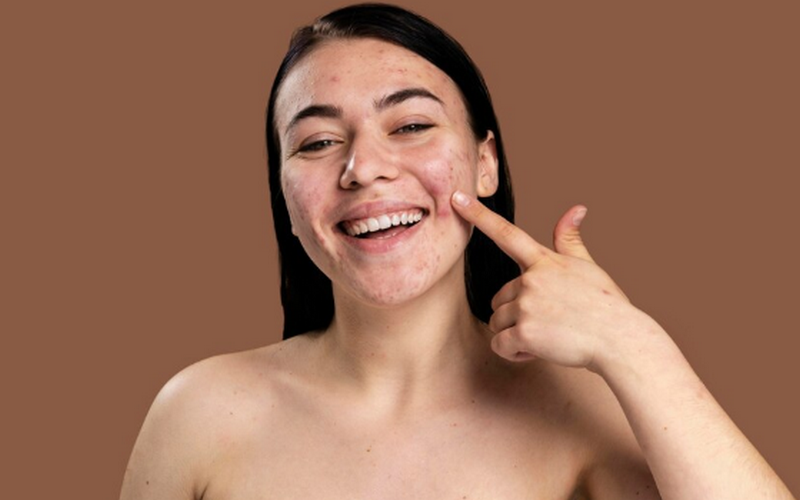 Mụn trứng cá bọc sưng đau và cách kiểm soát