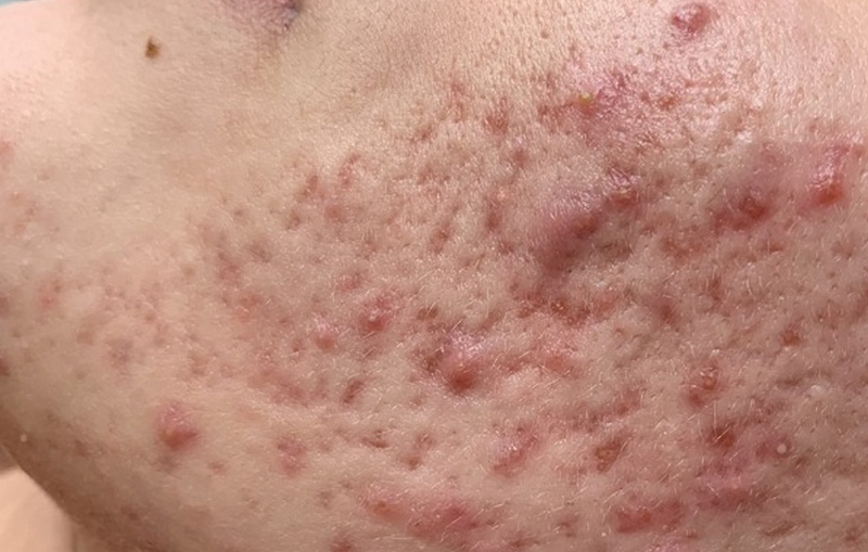 Trị mụn cấp tốc tại nhà bằng cách nào tốt nhất